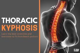 Stretches Exercises To Fix Thoracic Kyphosis For Good Exercise Kyphosis Exercises Thoracic