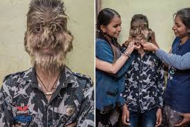 Of all the places to have werewolf syndrome, that is probably the coolest place to have it. Schoolboy 13 With Werewolf Syndrome Has Entire Face And Body Covered In Hair Uk News Newslocker