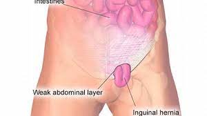 Orang yang masuk angin bisa mengalami badan pegal, perut kembung, begah, sering buang angin atau sendawa, mual, batul, pilek, demam, sampai menggigil. Angin Pasang Hernia Punca Simptom Dan Rawatan The Diagnosa