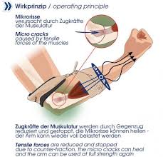De tenniselleboog is relatief makkelijk te behandelen. Masalo Manschette Bei Tennisarm Golferarm Wirkprinzip Tennis Arm Tennisarm Arm