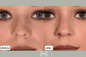 Straightening and narrowing the bridge is one of the most challenging ways  to use filler for non-surgical rhinoplasty, but small changes can make a  big improvement like they did for this patient. .