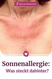 Sonnenallergie Behandeln Diese Mittel Helfen Dagegen Sonnenallergie Allergie Sonnenbrand