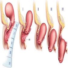 Image result for Rectal prolapse