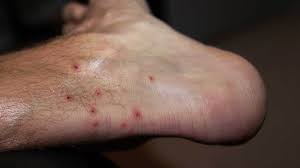 Chigger Bites Vs Bed Bug Bites Telling Them Apart