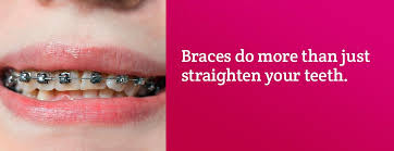 Webmd knows what it takes to get a straighter smile. How Long Do Braces Take To Straighten Your Teeth Teethwalls