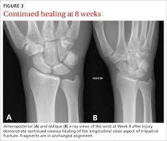 20 Year Old Male College Basketball Prospect Wrist Pain After Falling On Wrist Normal Rom Pain With Active Passive Wrist Extension Dx Mdedge Family Medicine They are frequently seen as dorsal chip fractures only on the lateral projection since the. wrist pain after falling on wrist