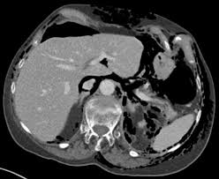 You increase your cancer risk far more by sunbathing on a vacation beach for two weeks than by having. Mistakes In Acute Abdominal Ct And How To Avoid Them Ueg United European Gastroenterology