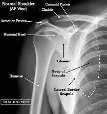 Anterior Shoulder Dislocation General Review Radiology Student Radiology Basic Anatomy And Physiology