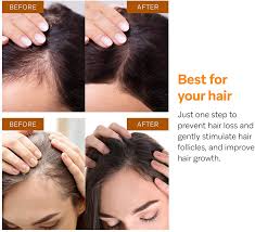 Here are some of the best treatment options for thinning hair. Buy Hair Growth Serum By Azally Best Treatment For Hair Thinning Hair Loss Prevention Treatment For Men Women With Thinning Hair Online In Turkey B07v6l45h5