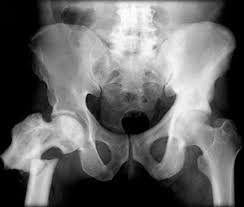 Paget S Disease You And Your Hormones From The Society For Endocrinology
