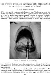Maybe you would like to learn more about one of these? Non Specific Tonsillar Infection With Perforation Of The Faucial Pillar In A Child The Journal Of Laryngology Otology Cambridge Core