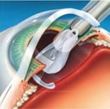 Maybe you would like to learn more about one of these? Cataracta