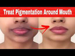 See full list on wikihow.com Get Rid Of Dark Black Patches Dark Upper Lips Darkness Around Mouth Youtube