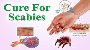 Kudis buta dianggarkan telah menjangkiti sekitar 200 juta orang pada peringkat. Treatment Of Scabies Kudis Buta Hsijbv2