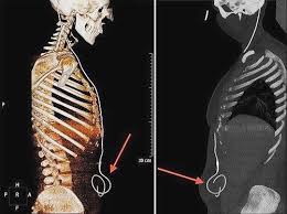 Ventriculoperitoneal Shunt Atau Vp Shunt Brain And Spine Center Surabaya Facebook