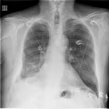 The diagnosis of mesothelioma should be considered in any patient with a unilateral pleural effusion or thickening, especially if chest pain . Epithelioid Mesothelioma Radiology Case Radiopaedia Org