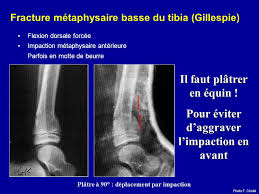 Fractures De L Enfant Ppt Telecharger