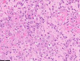 Desmoplastic mesothelioma cancer is a sarcomatoid mesothelioma type that has more than a half of collagenized stromae dense. Pathology Outlines Mesothelioma Pleura Epithelioid