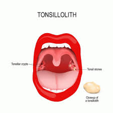 Medical websites suggest using a cotton swab to take it out. Tonsil Stones Symptoms Treatment University Health News
