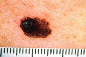 This is done in the operating room by a. Stage 4 Melanoma Survival Rate Pictures And Treatment