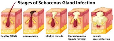 Image result for Sebaceous Gland