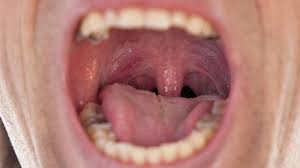 A sample of tissue may be removed to look for the presence of cancerous cells. What Does Stage 1 Throat Cancer Look Like