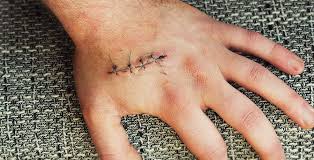 Image result for Skin Tear