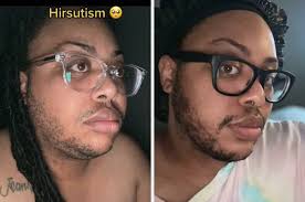 A sudden increase in hair growth or loss in women is often caused by an imbalance of male hormones (androgens) which are naturally present in both men and women in differing amounts. Hirsutism This Tiktok Woman Is Trying To Normalize It