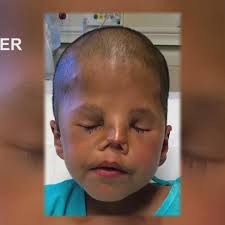 Boy from Gaza recovering after medical care in Shreveport