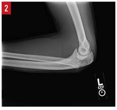 Image result for Radial Head Dislocation