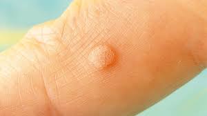 However, the visible appearance of … Hpv Symptoms Warts Genital Warts Cancer Everyday Health