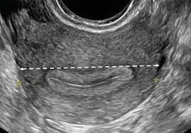 The patient must have had a documented complete pelvic ultrasound within the last 6 months; Normal Ultrasound Female Pelvic Anatomy Springerlink