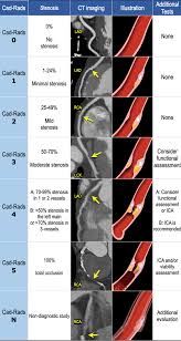 Fibromuscular dysplasia is a cause of renal artery blockage. The Radiology Assistant Coronary Artery Disease Reporting And Data System
