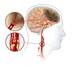 Image result for carotid artery