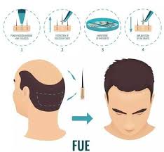 Difference Between Fue And Dhi Method Dr Caymaz Hair Transplant Find pick pen from a vast selection of healthcare, lab & dental. difference between fue and dhi method