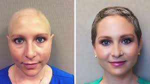 Not everyone who undergoes chemotherapy loses their hair since some of the drugs used in the process do not cause total hair loss. National Hair Loss Chemotherapy Hair Loss Regrowth Youtube