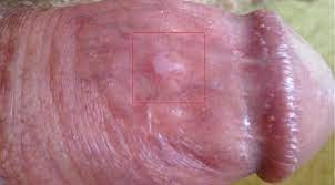 Vorbeugende Massnahmen Und Behandlungsmethoden Ursachen Und Behandlung Von Weissen Flecken Auf Dem Penis