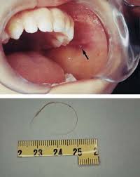 Image result for Sialolithiasis