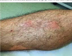 Image result for Trombicula autumnalis bites