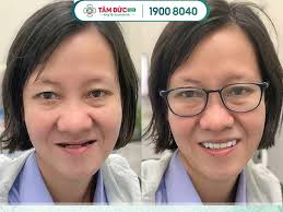 Địa chỉ làm hàm tháo lắp TPHCM uy tín