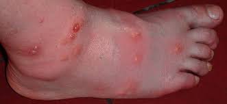 In these cases a normal mosquito bite developing into a large welt days after the initial bite. Mosquito Borne Diseases In Thailand Pattaya Unlimited