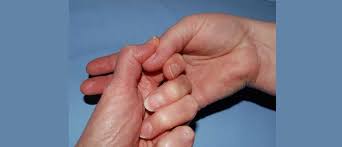 This test is called the finkelstein test. Finkelstein S Test Handlab Resources