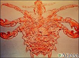 Image result for pubic lice symptoms