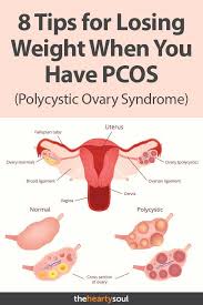 Pin On Pcos Weight Loss