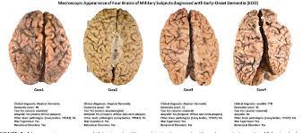 Maybe you would like to learn more about one of these? Pdf Early Onset Dementia In War Veterans Brain Polypathology And Clinicopathologic Complexity Semantic Scholar
