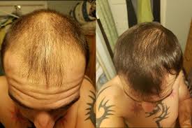 Methodical & non conventional hair loss treatment available with few good homoeopathy clinics in india & abroad, since my sister has taken treatment at dr satsangis clinic with dr manish satsangi at delhi greater kailash 1 branch minoxidil is the only topical hair loss treatment that is fda approved. Morr F Topical Solution Review Does It Work As Hair Loss Treatment Morr F Topical Hair Regrowth