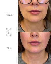 VOLUME LOSS ON JAWLINE + CHiN