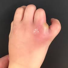 Image result for phlegmon of hand)