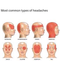 Image result for Acute Localized Headache
