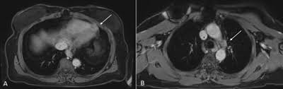 Thoracic ct scan demonstrated prominent pericardial effusion, irregular calcified thickenings of the pleura, partial collapse of the lower lung fields, . Recurrence Of Pericardial Mesothelioma Affecting The Myocardium After Pericardial Resection The Annals Of Thoracic Surgery
